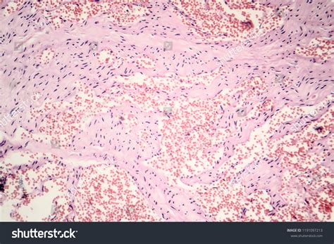 Capillary Hemangioma Light Micrograph Photo Under Foto Stock 1191097213