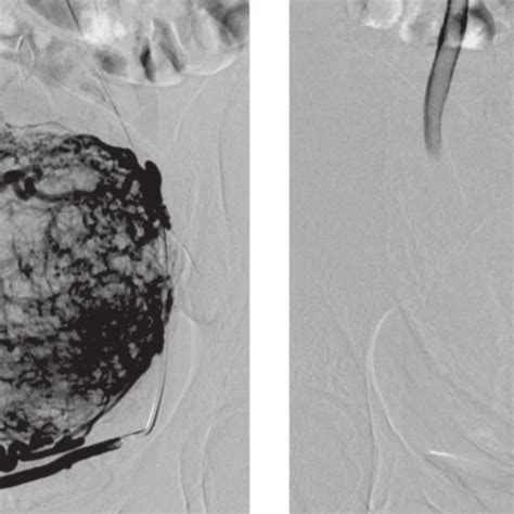 Results Of Selective Right Uterine Artery Angiography Before A And