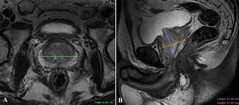 Prostate Volume Estimation On Mri Accuracy And Effects Of Ellipsoid And Bullet Shaped