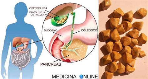 Sintomi Di Colica Biliare Riconoscere I Sintomi Delle Off