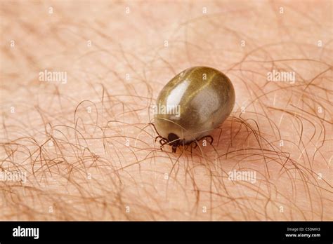 Single Well Fed Tick On Human Skin Stock Photo Alamy