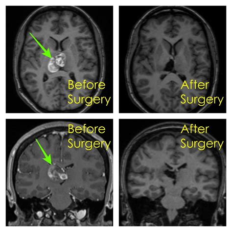 Cavernoma Surgery