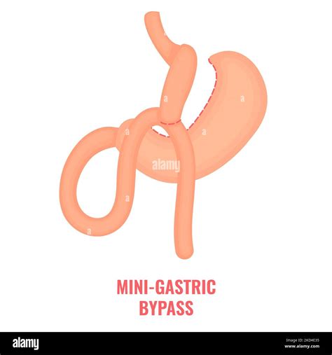 Mini gastric bypass bariatric surgery, illustration Stock Photo - Alamy