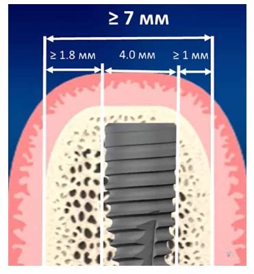 Implant Diameter How To Choose The Best One