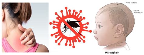 Zika Virus Infection Causes Sign And Symptoms Mode Of Transmission Diagnosis Complication