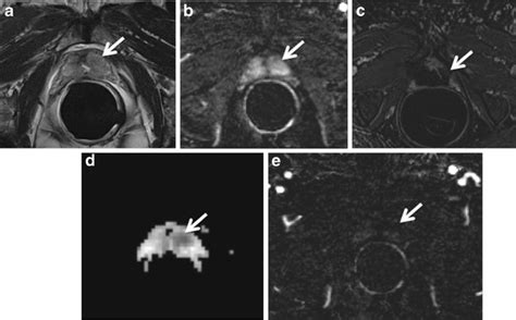 3 Post Mrgfus Treatment A Pre Treatment Axial T2 Weighted Fast