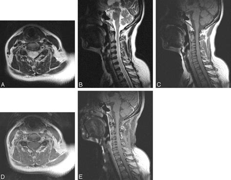 A 47 Year Old Woman With A Nonenhancing WHO Grade III Anaplastic