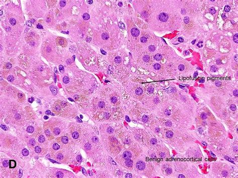 American Urological Association Adrenocortical Adenoma