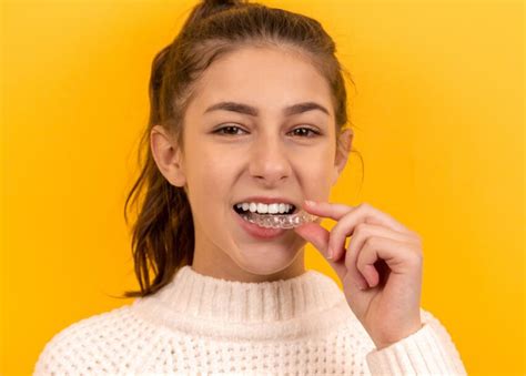 How To Put Rubber Bands On Invisalign Aligners Sensational Smiles