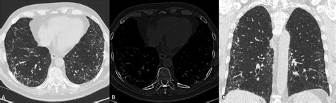 A B C High Resolution Computed Tomography Hrct Scan Lung A And