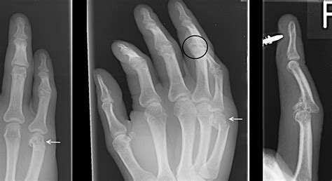 Phalangeal Fractures Of The Hand Clinical Radiology