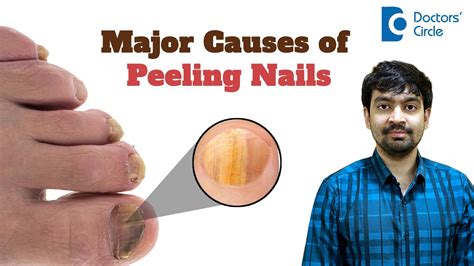 5 Reasons For Flaky Peeling Nails Cracked Nail Cure Nail Care Dr