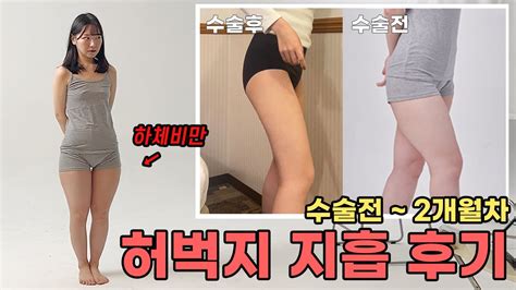 일본에서온 역대급 하체비만녀의 허벅지 지흡 레전드 후기 수술전~2개월차 Youtube