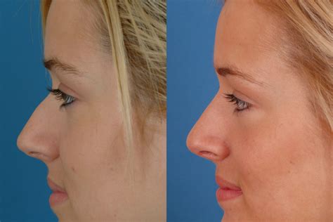 Rhinoplasty Before And After Photos Dr Benjamin Bassichis