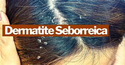 Dermatite Seborreica Causas E Sintomas Pharma Scalabis