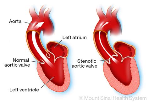 Aortic Stenosis Diagnosis And Treatments Mount Sinai New York