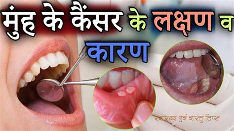 मुंह के कैंसर के लक्षण व कारण Symptoms And Causes Of Mouth Cancer In