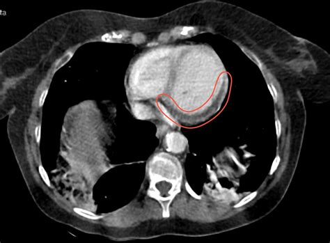 Acute Posterolateral Myocardial Infarction Diagnosed On Contrast