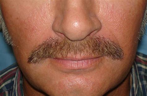 What Is Mustache Transplant Before And After Prices