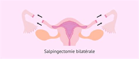 Salpingectomie Comment Retirer Les Trompes De Fallope