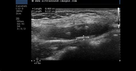 Ultrasound Imaging Carotid Artery Atherosclerotic Plaques Moderate Stenosis