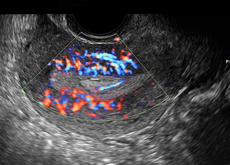 Gynecologic Ultrasound