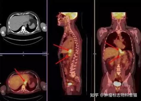 什么时候需要做pet Ct？价格这么贵医保是否报销？ 知乎