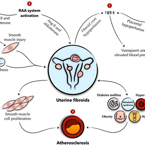 Schematic Presentation Of The Association Of Uterine Fibroids With