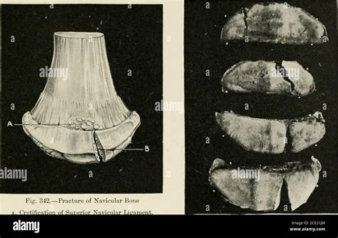 Fracture Os Naviculaire Pied Banque De Photographies Et Dimages à