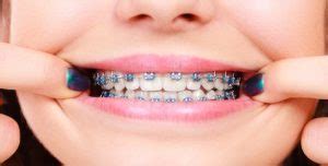 Color de las ligas de los brackets Clínica Dental Everest