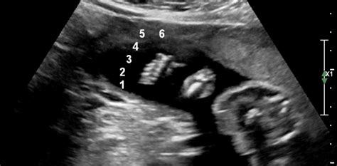 Scan of the Week: 6 toes during a 20 Week Scan - Ultrasound Scan Dublin ...