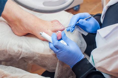 Tratamiento podológico Podólogo tratando hongos en las uñas El médico