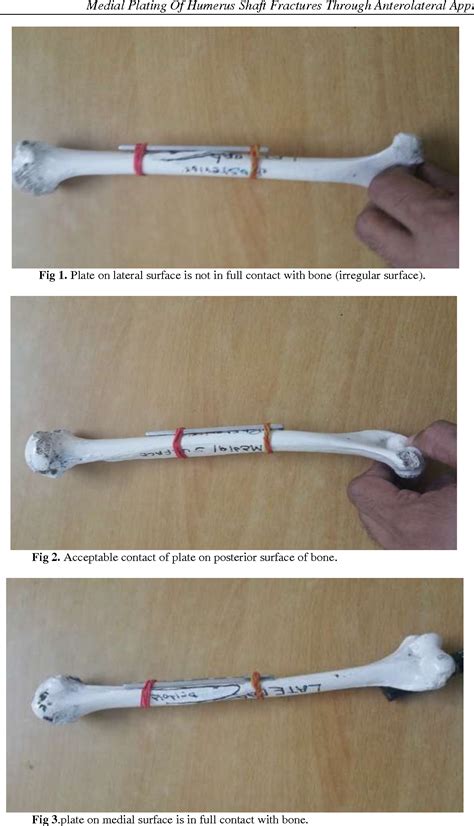 Figure 1 From Medial Plating Of Humerus Shaft Fractures Through Anterolateral Approach