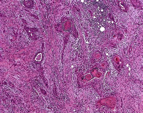 The Metastatic Node Consists Of A Well Differentiated Squamous Cell