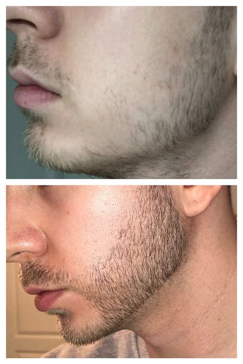 Minoxidil Beard Growth Before And After