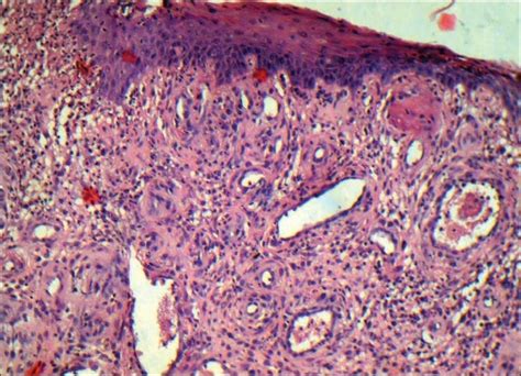 Photomicrograph Shows Hyperplastic Parakeratinized Stratified Squamous