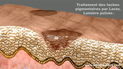 Traitement Des Tâches Pigmentaires Au Laser Dr Barry Youtube