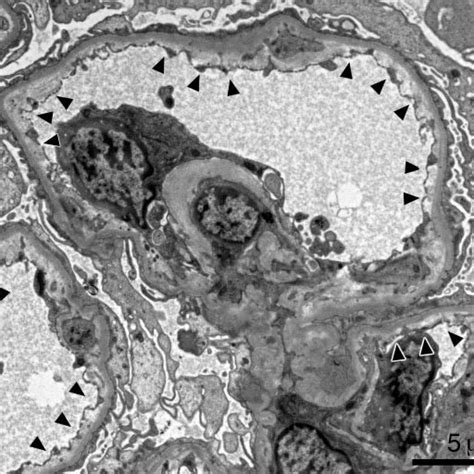 Electron Microscopy Findings Of Renal Biopsy Subendothelial Widening