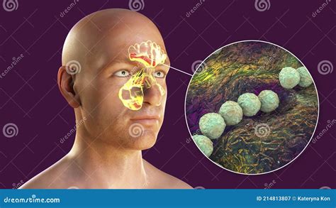 Inflammation Of Frontal And Maxillary Sinuses In A Man And Close Up