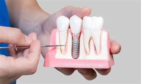 The Link Between Dental Implants And Bone Health