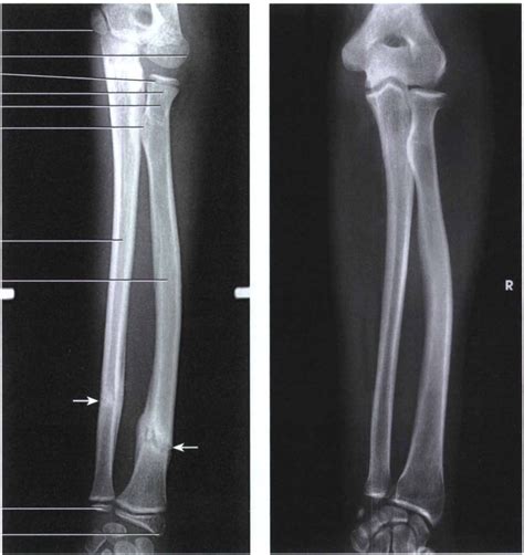 Gudang Medis Teknik Radiografi Antebrachii