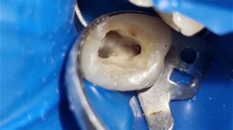 Endodontia Obturação Dos Canais Dente 16 Youtube