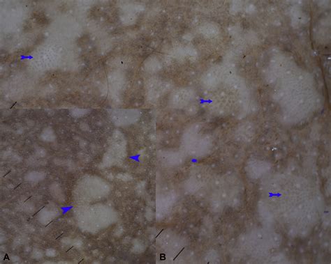 Dermoscopy Of Acrokeratosis Verruciformis Of Hopf Journal Of The