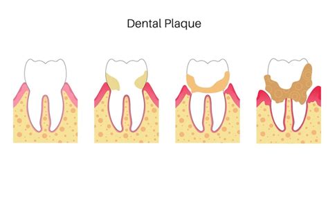 Premium Vector Vector Illustration Of Dental Plaque Stages Tooth