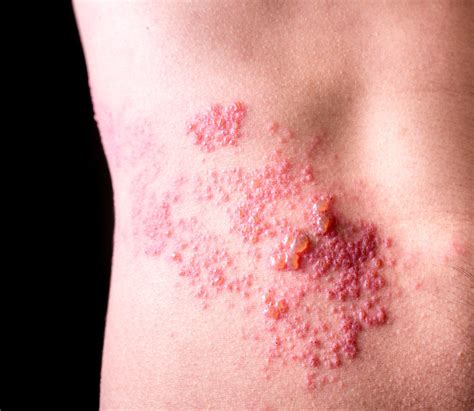 Shingles Herpes Zoster Katu Dermatology Clinic