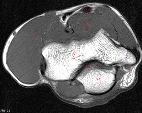 Schaubild Schnittbildanatomie Ellenbogen TRA Quizlet