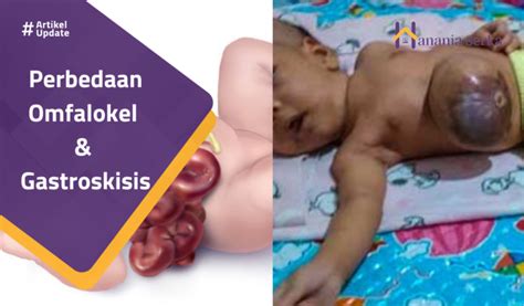 Perbedaan Omfalokel Gastroskisis Hanania Serka