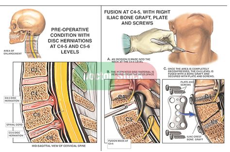 C4 5 And C5 6 Disc Protrusions With Spinal Fusion Surgery Doctor Stock