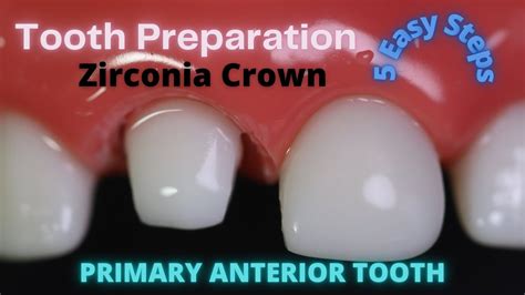 Tooth Preparation For Anterior Zirconia Crown🟡signature Crowns🔴preformed Pediatric Zirconia