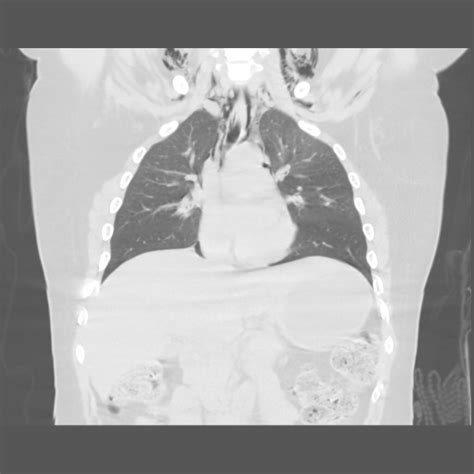 Pneumomediastinum: with continuous diaphragm sign | Image | Radiopaedia.org